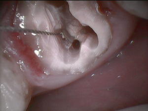 歯の構造｜根管の形態|香川県高松市の薬で治す治療法｜吉本歯科医院