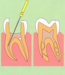 なるべく歯を削らず薬でなおす虫歯治療なら高松市の吉本歯科医院