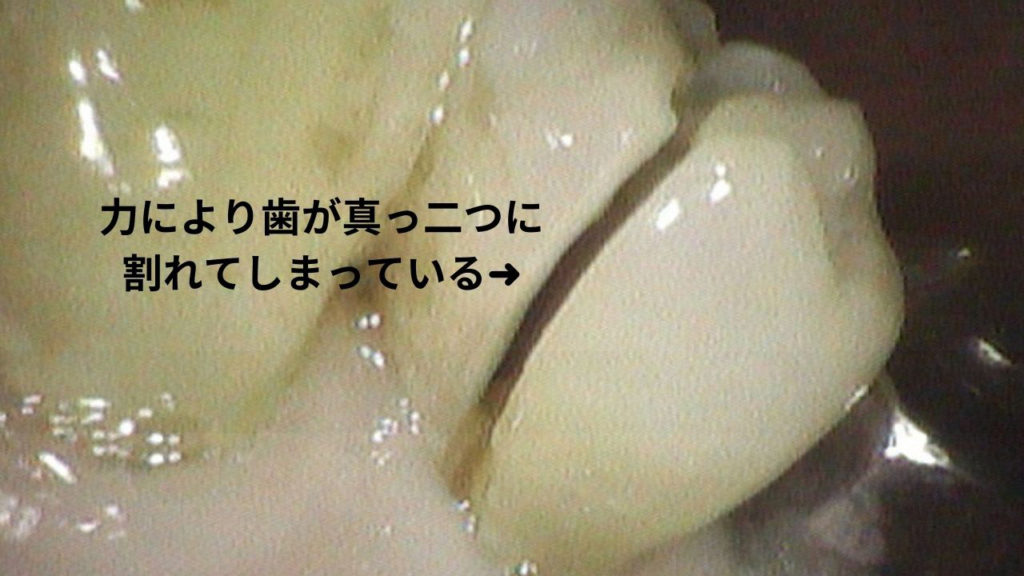 なるべく歯を削らず薬でなおす虫歯治療なら高松市の吉本歯科医院